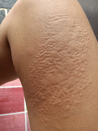 Skin allergy.