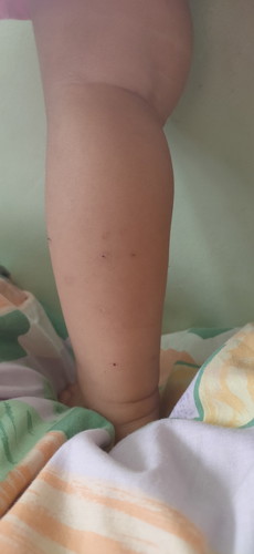 (G6pd+) Baby Mosquito bites