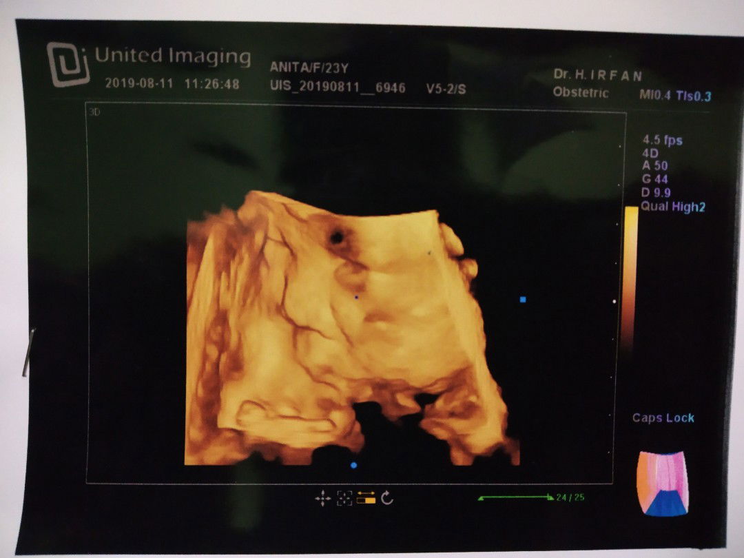 hasil usg 34mgg