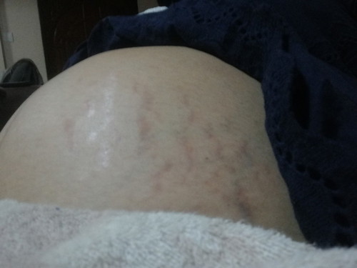 เป็นสิบขีดแบบนี้ท้องมั้ยคะ??