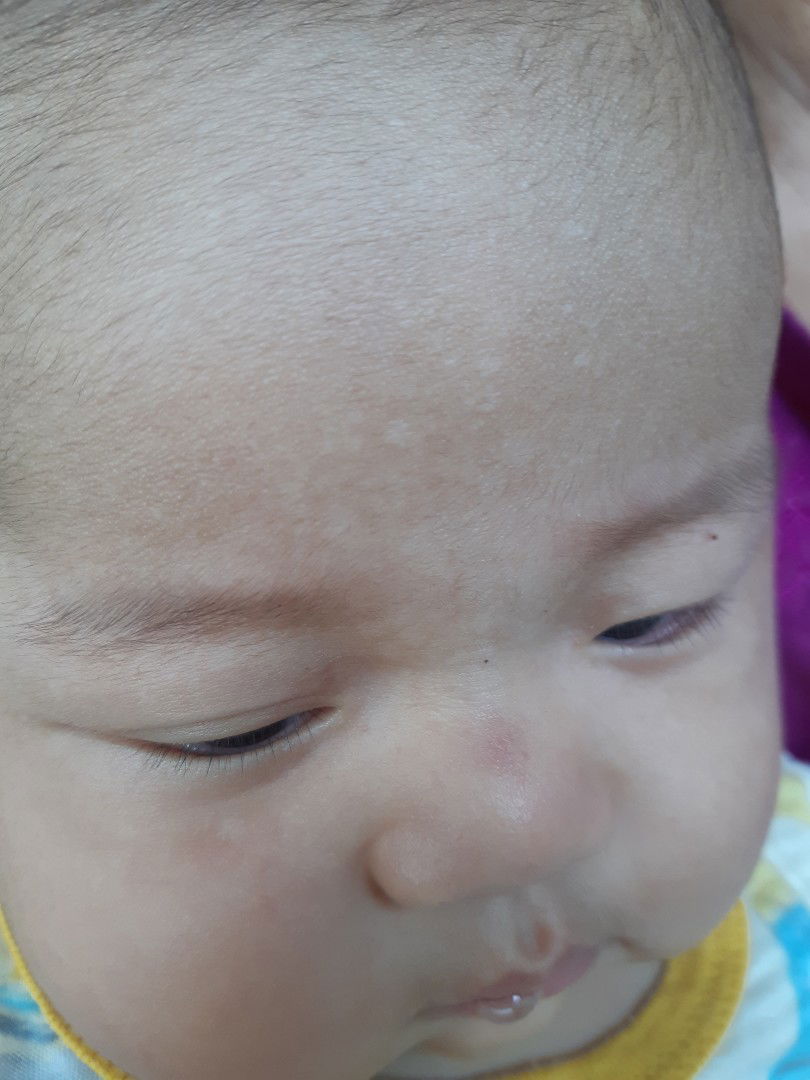 bé bị đốm trắng