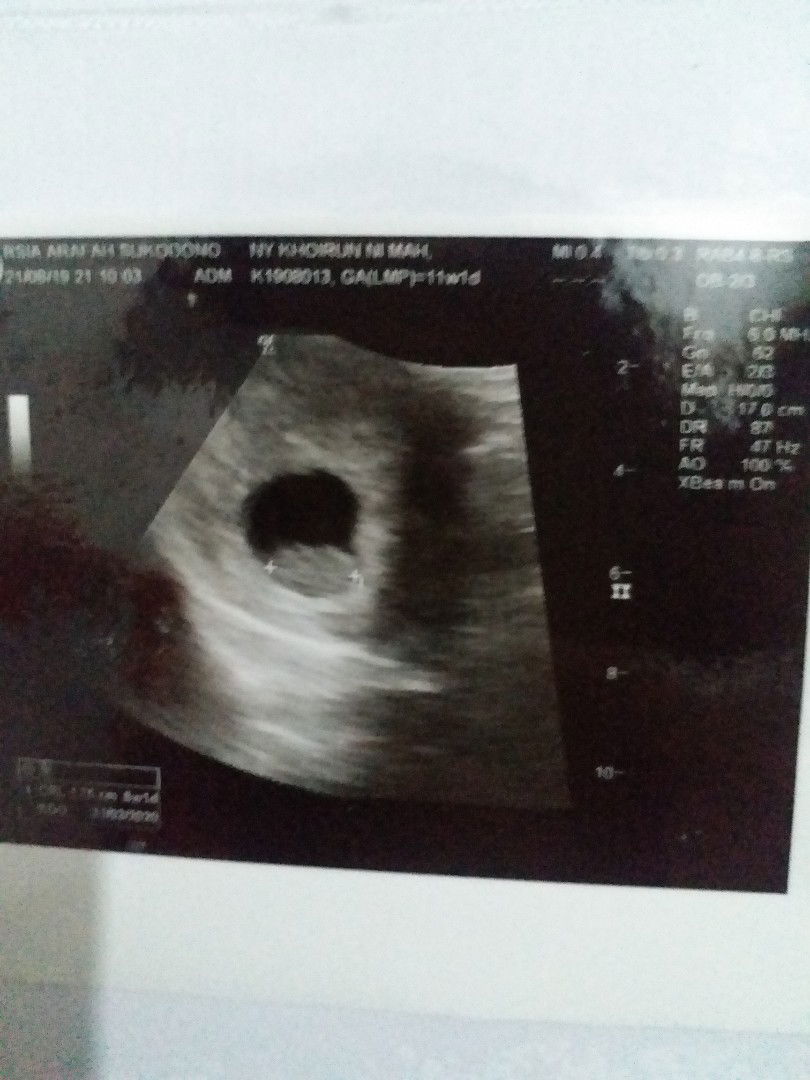 jantung tdk kelihatan