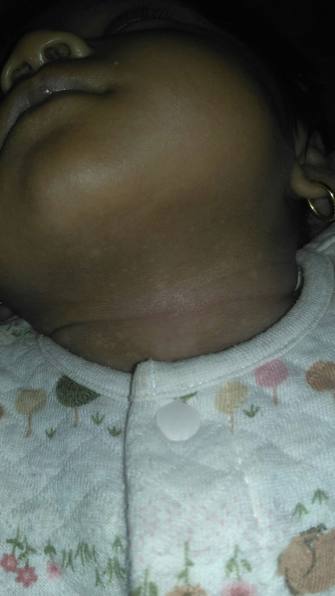 bercak putih dileher dan muka bayi