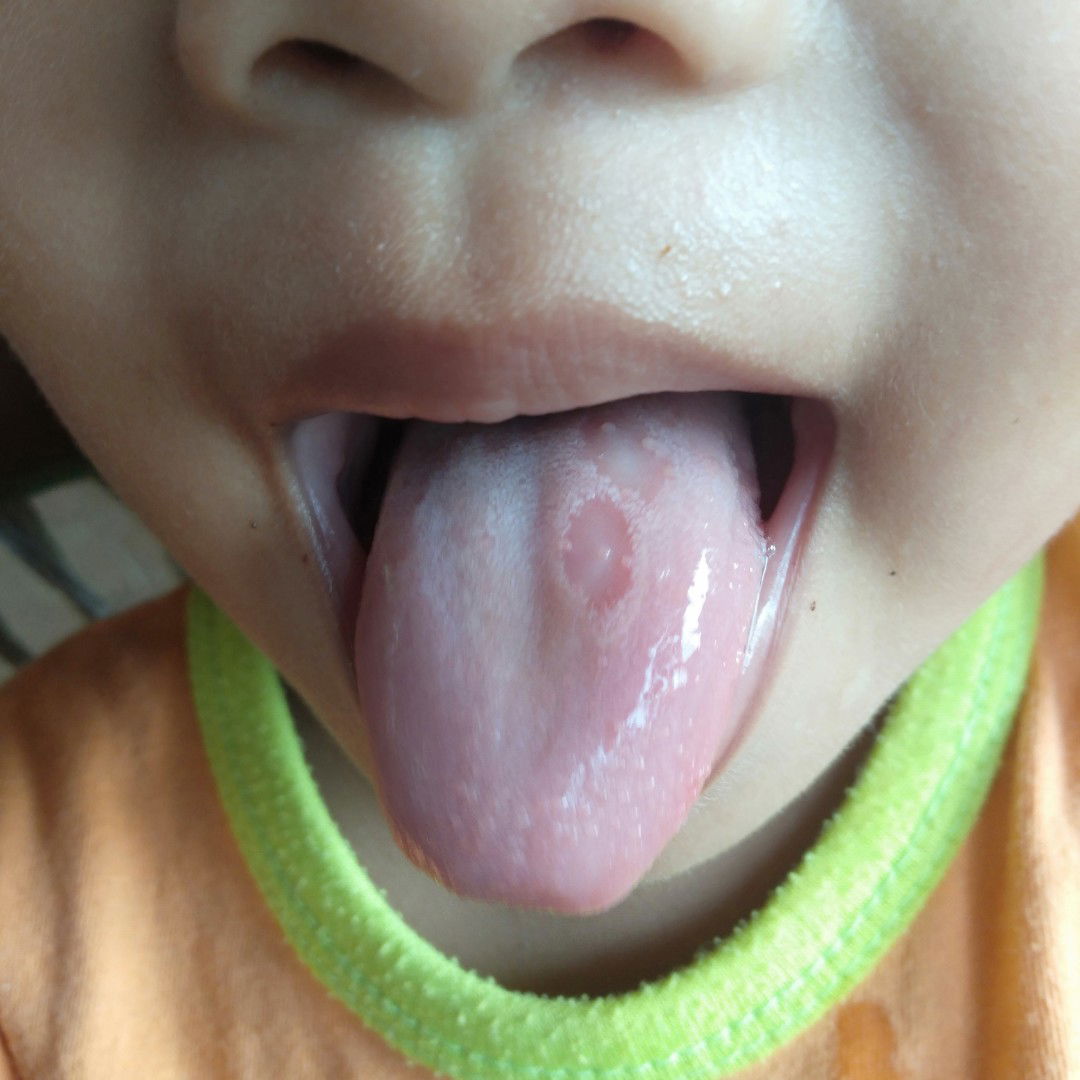 อยากทราบว่าลิ้นลูกเป็นอะไร