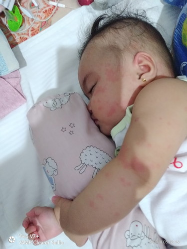 skin rash or allergy