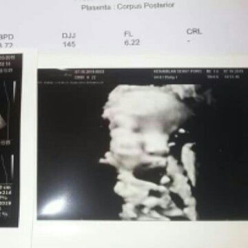 hasil usg hari ini 35w