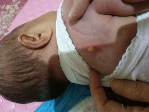 bisul pada punggung bayi