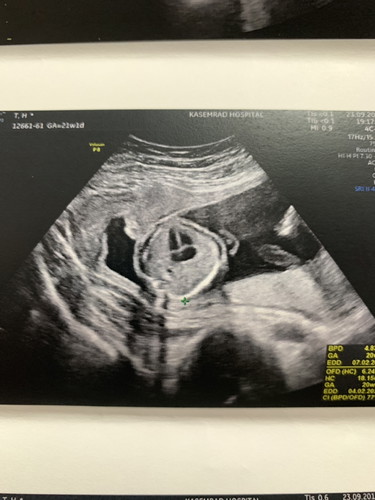 ผนังกั้นหัวใจตอนอยู่ในครรภ์ 21 w