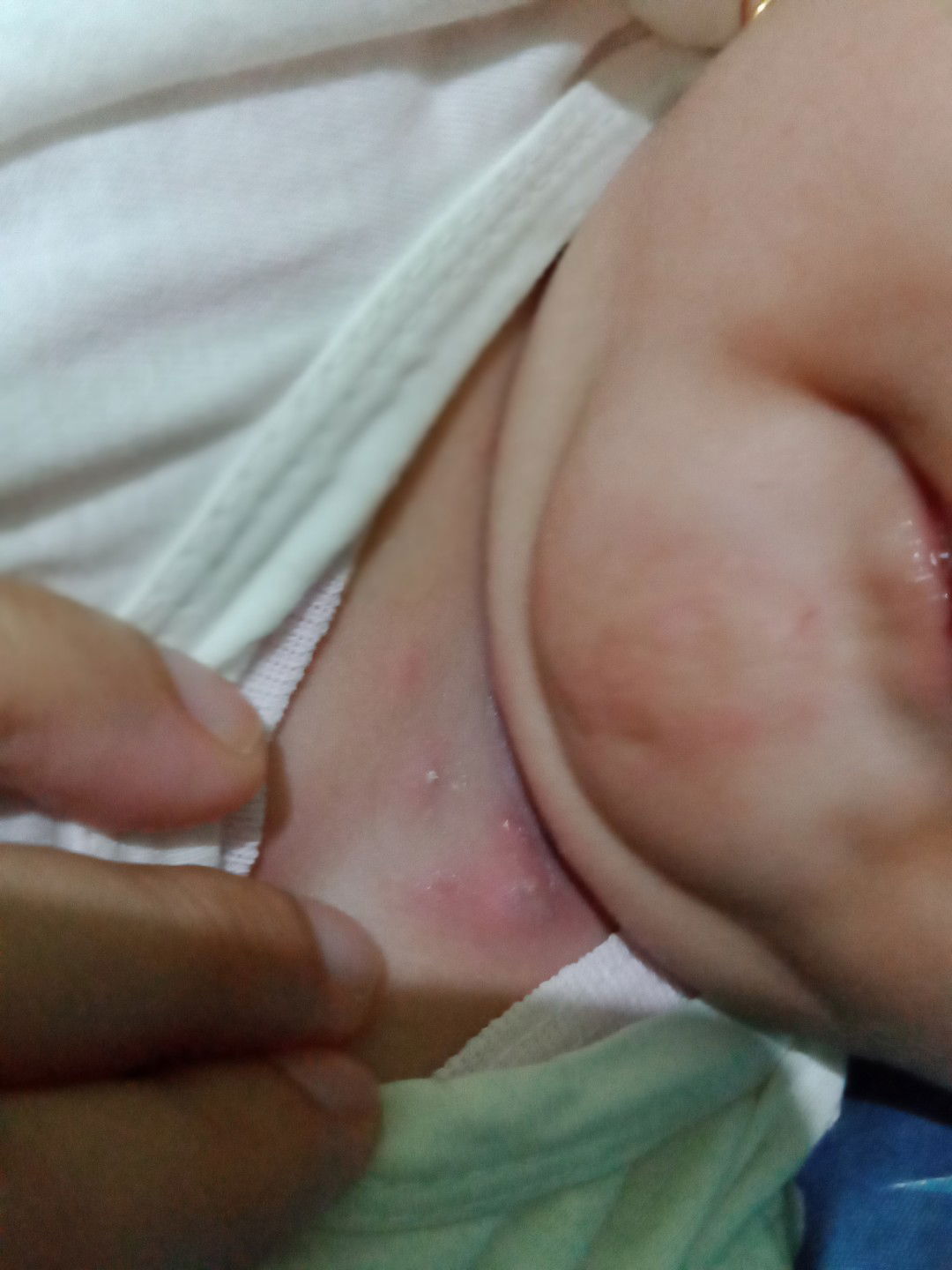 gatal pada leher bayi