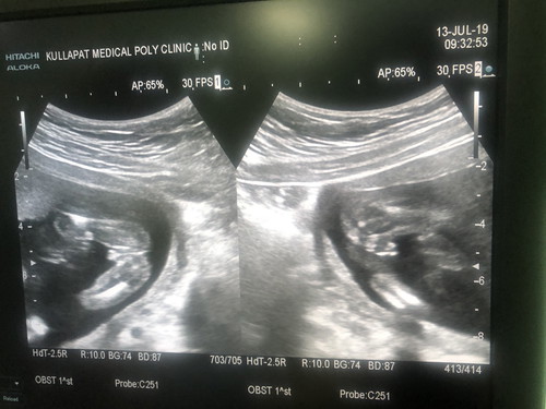 20 Week
