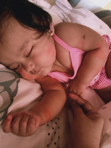 Baby Skin Rashes