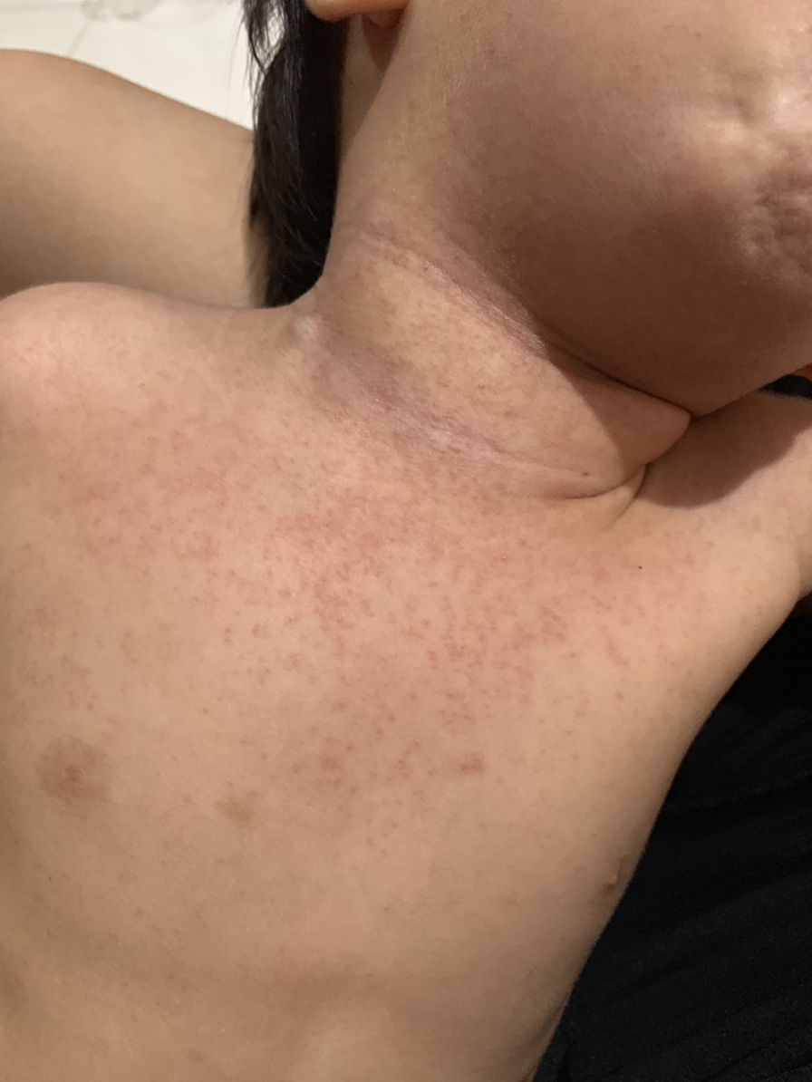 Ini alergi atau biang keringat ya?