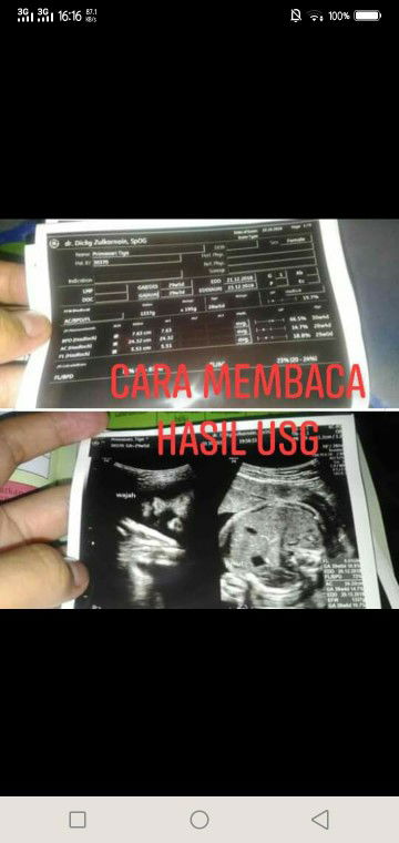 cara membaca hasil USG, semoga bermanfaat yaa bunda²??