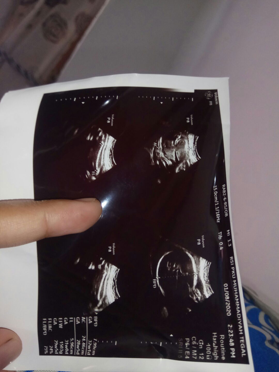 32 week masih sungsang