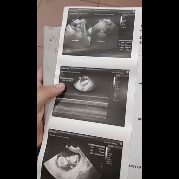 AKALA KO HINDI NABUO ANG BABY KO