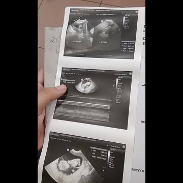 AKALA KO HINDI NABUO ANG BABY KO