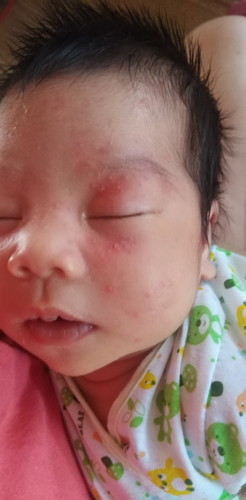 น้องหน้าเป็นผื่นแบบนี้ค่ะ