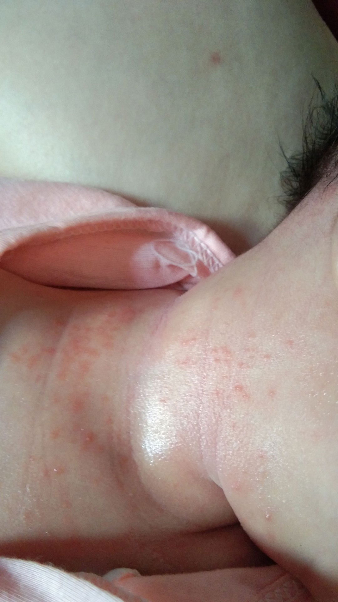 merah2 alergi atau biang keringet ya?