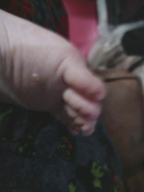 melepuh di kaki bayi