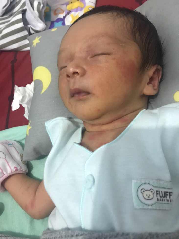 muka dan badan anak ruam2 merah