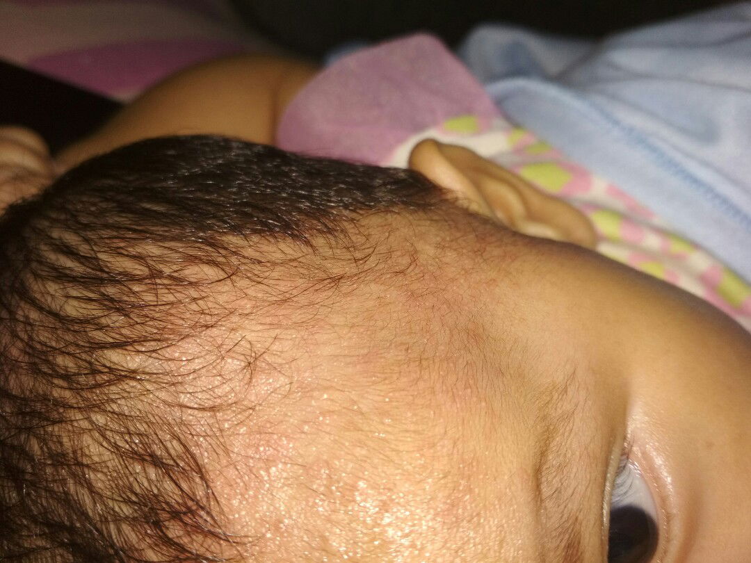 biang keringat pada bayi