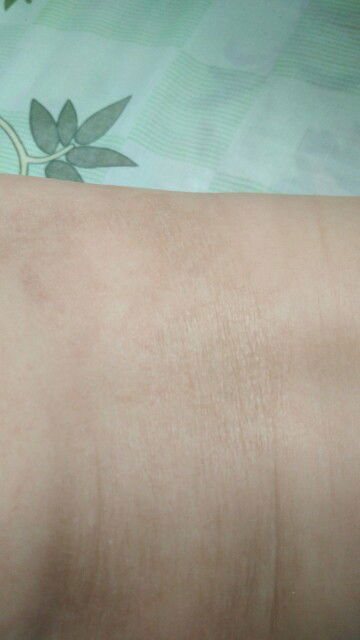 kulit kering dan biang keringat pada tubuh bayi