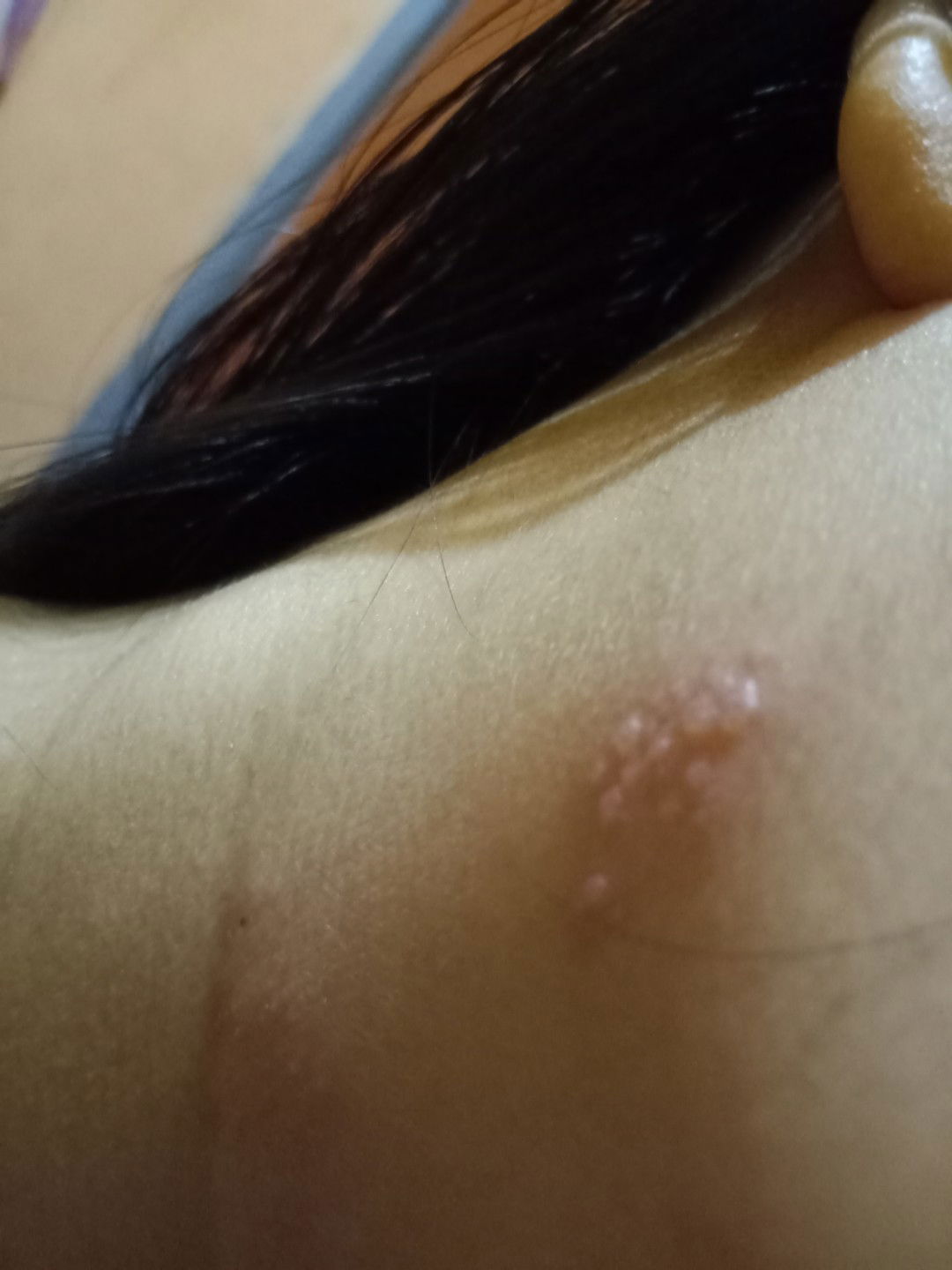 Terkena herpes saat hamil