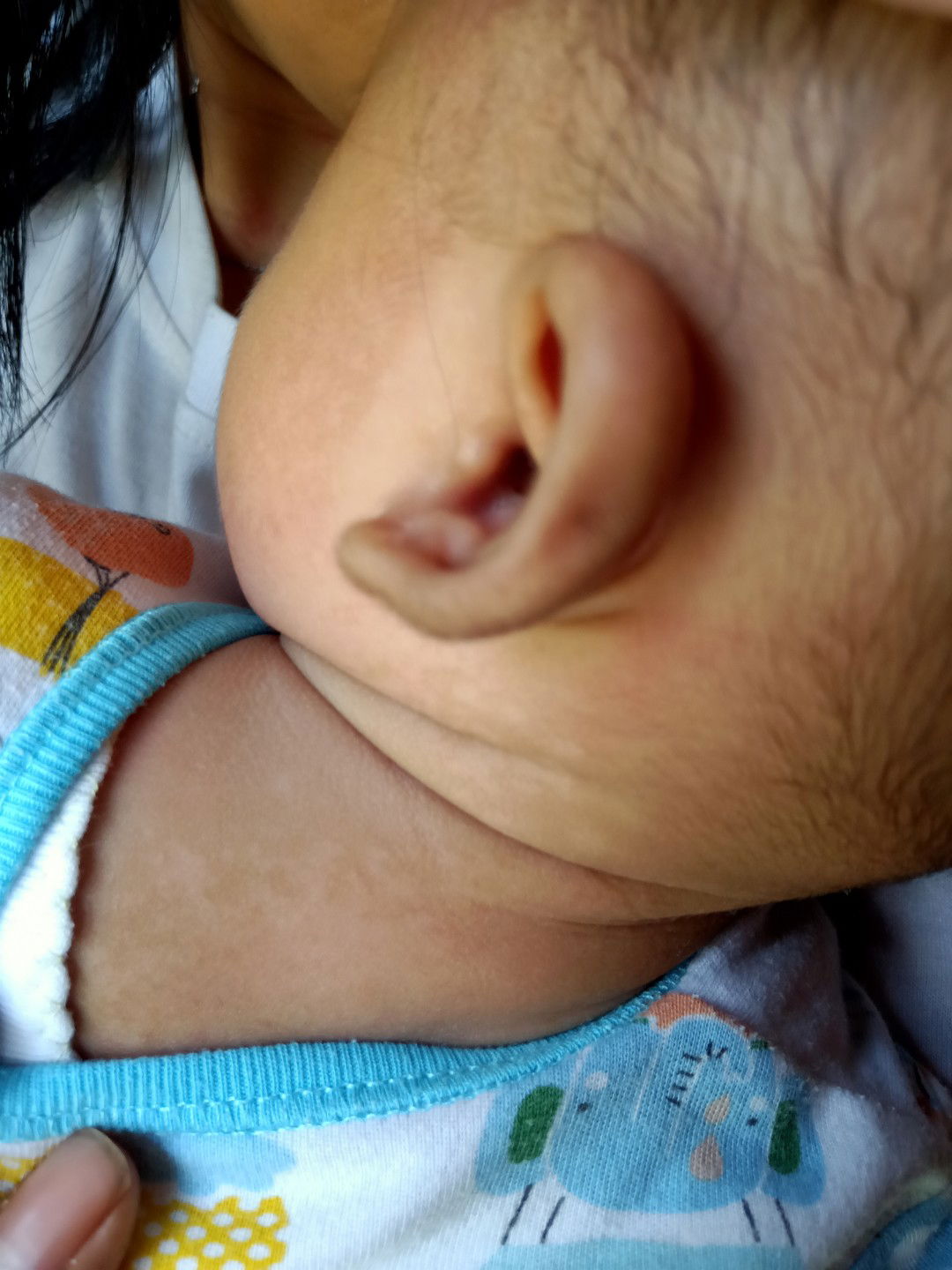 putih putih di kulit seperti panu