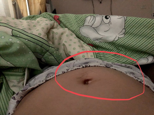 ท้องปูด ??