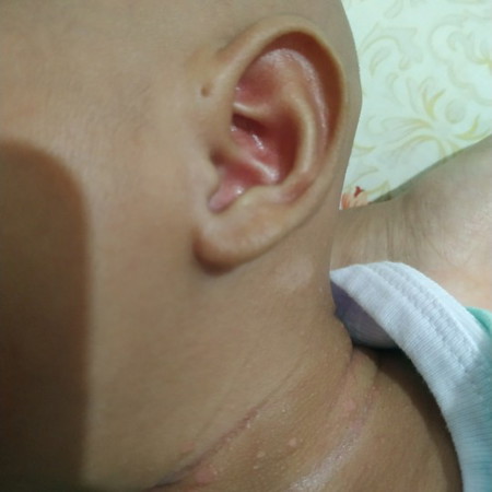 Luka seperti lecet dan kadas dileher