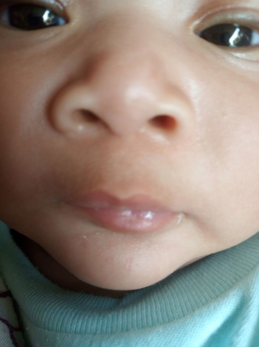 bintik merah pada bawah bibir dan atas bibir