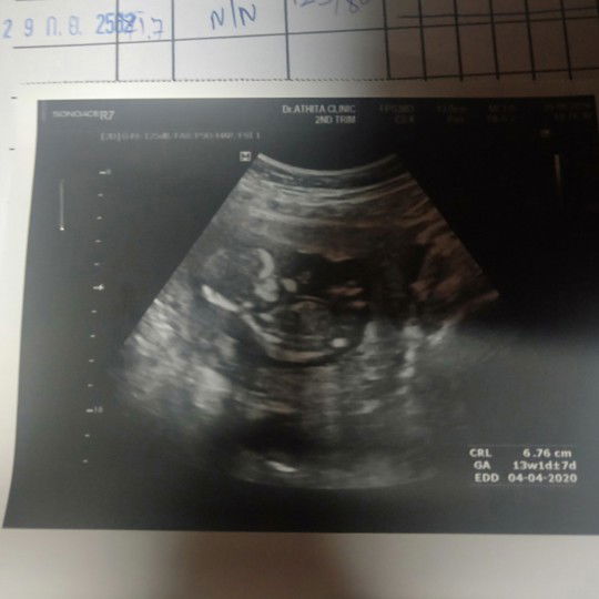 ขอสอบถามคนที่เคยแท้งหน่อยค่ะ