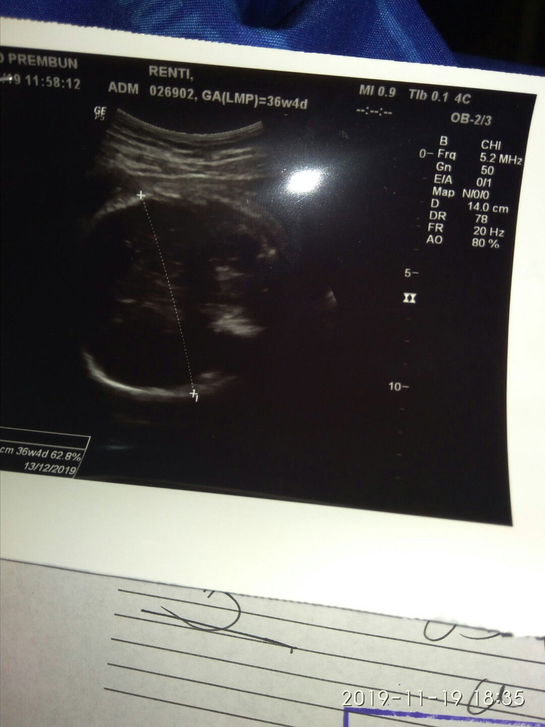 usg kurang air ketuban