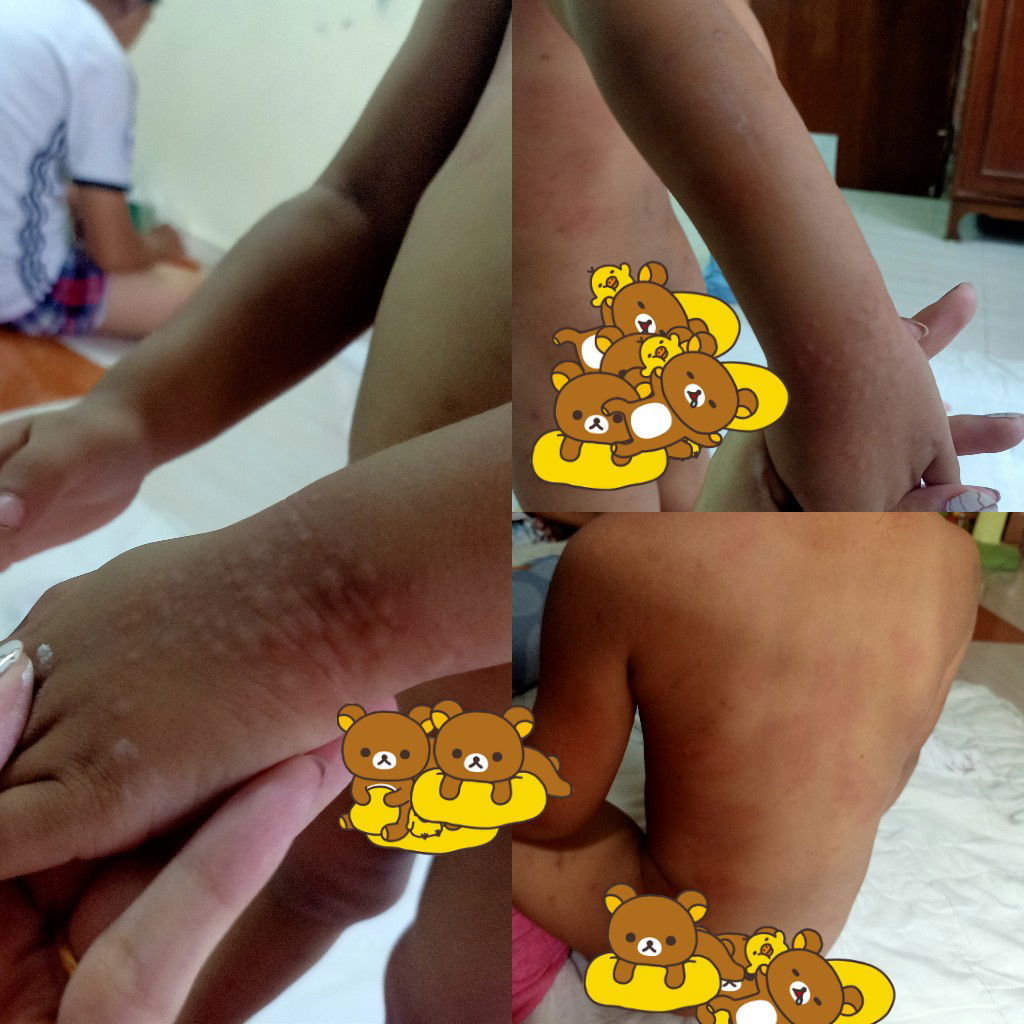 ลูกมีผื่นขึ้นเต็มตัวใช่ลมพิษใหมคะขอวิธีรักษาเบื้องต้นหน่อยค่ะกำลังจะพาไปหาหมอ