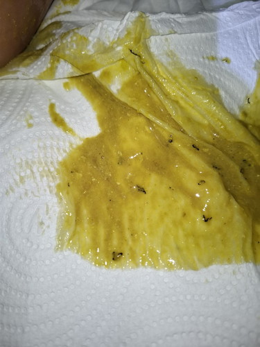 อุจาระแบบนี่ผิดปกติไหม?