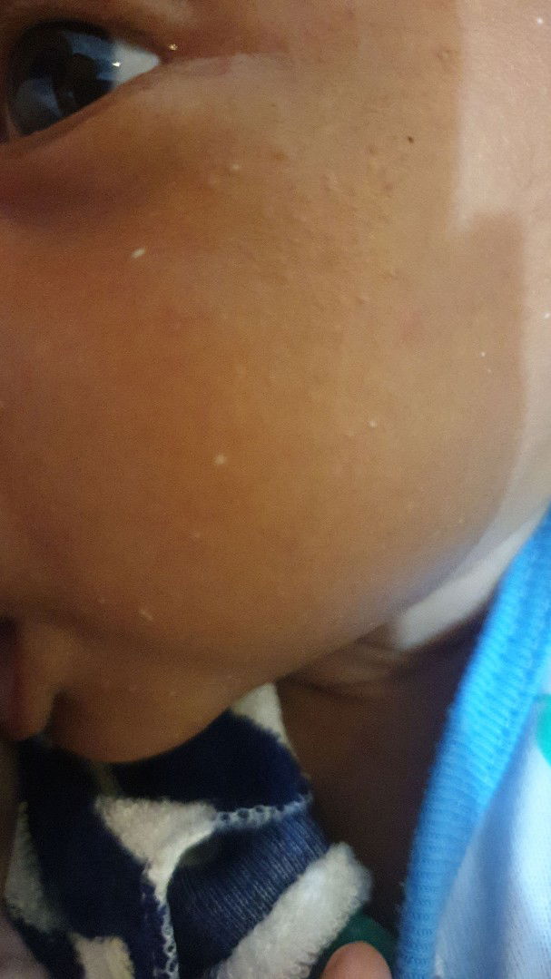bintik putih di wajah bayi