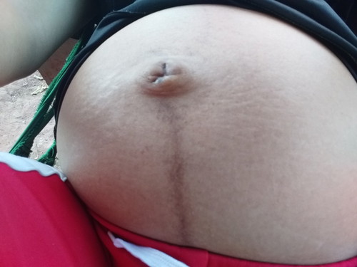 ท้องแตกลาย