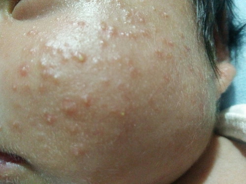 Newborn Acne?