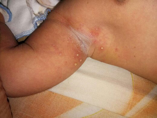 bun, ini biang keringa atau apa yah?