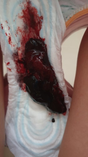blood clot