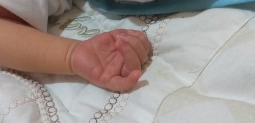 purplish skin for new born