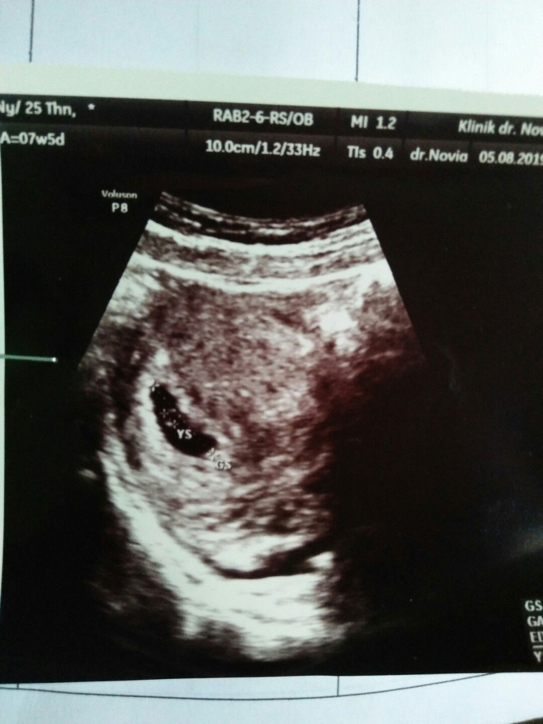 nyeri di bawah perut dan sakit pinggang