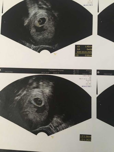 7 weeks ไม่เจอตัวอ่อน