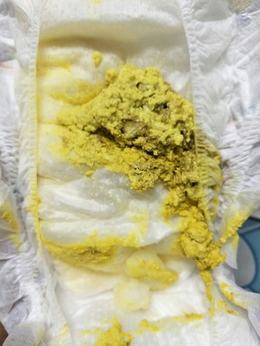 สีอุจจาระของลูก