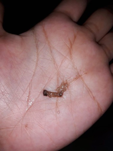 Flek coklat usia kandungan 11 minggu