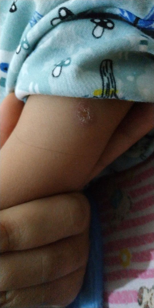 bekas suntik ada nanahnya