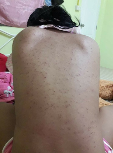 อาการ