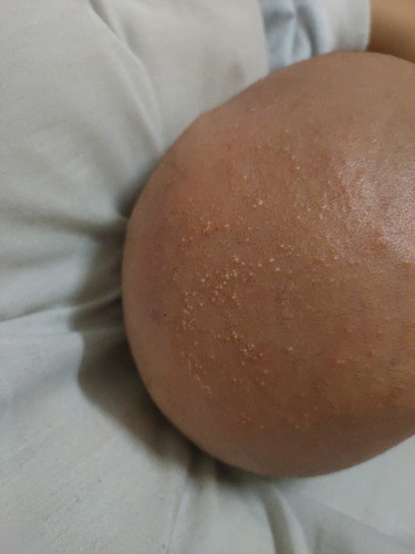 Ruam kepala bb