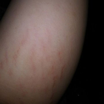 varises / strecth mark