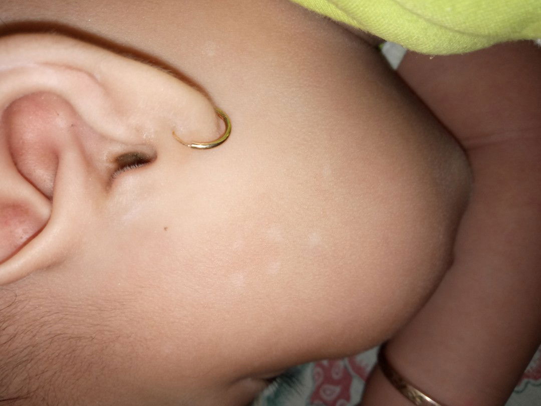 Bercak putih, Panu kah ??